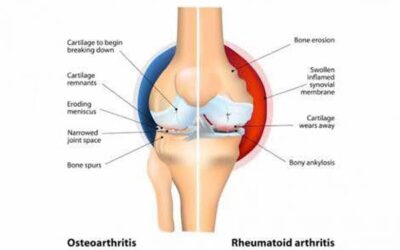 Heal Arthritis, Rheumatism and Osteoarthritis