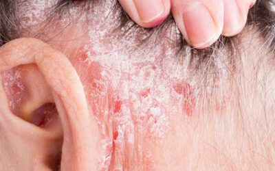 Heal psoriasis, eczema & other skin diseases